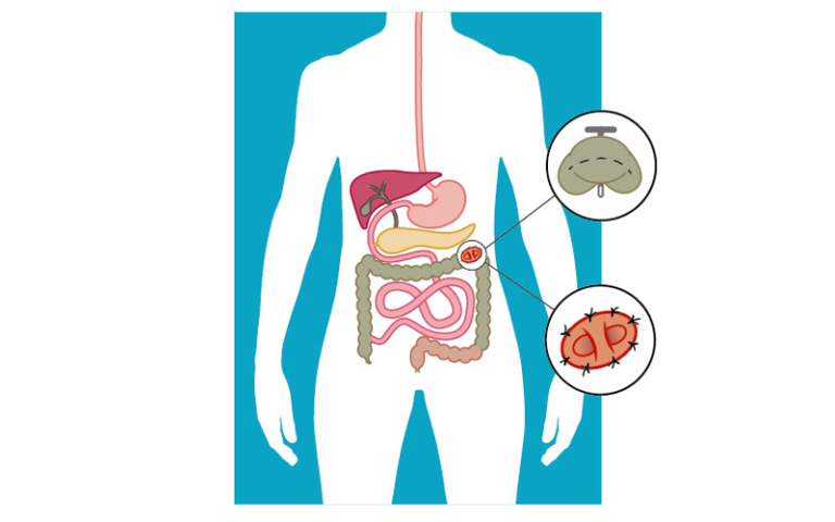 Operatie en aanleg colostoma - Stomavereniging